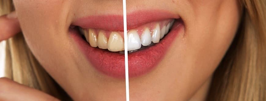 שיניים - לפני ואחרי טיפול הלבנה ושיפוץ